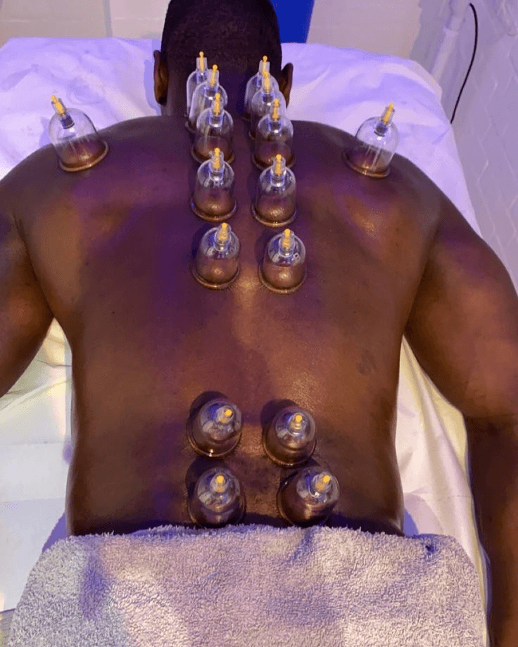Cupping Therapy